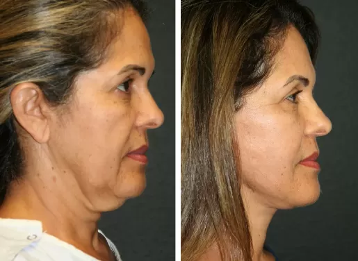 Facelift With Neck Lift 03