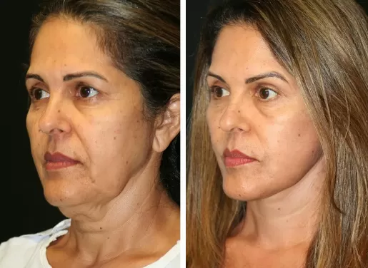 Facelift With Neck Lift 04