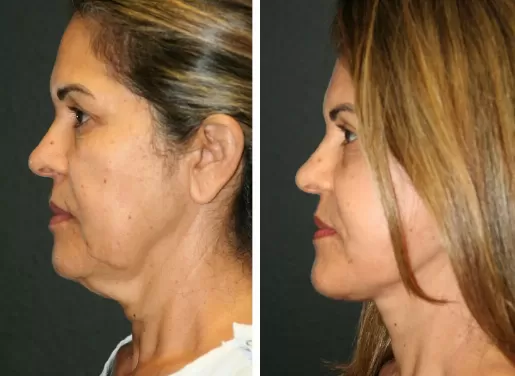 Facelift With Neck Lift 05