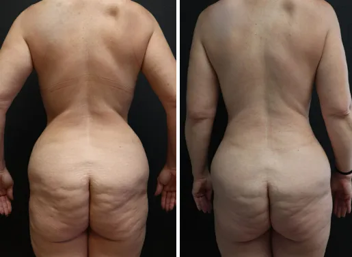 Tummy Tuck 06