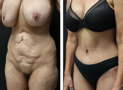 Tummy Tuck 05