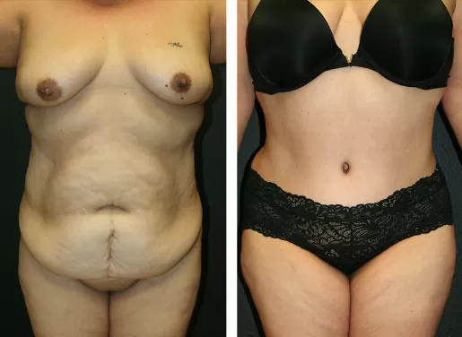 Tummy Tuck 04