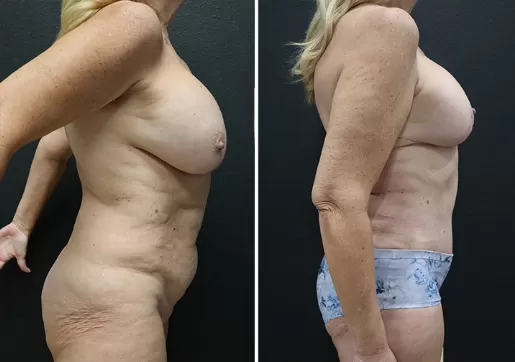 Tummy Tuck 05