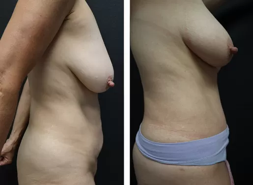 Tummy Tuck 03