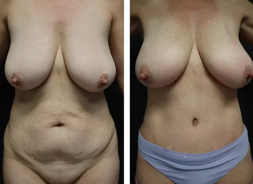 Tummy Tuck 04