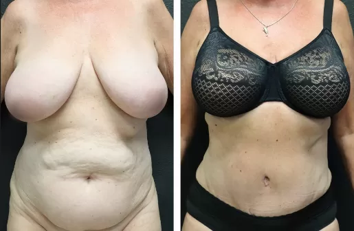 Tummy Tuck Tummy-Tuck-front