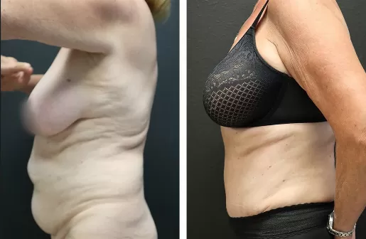 Tummy Tuck Tummy-Tuck-left-profile