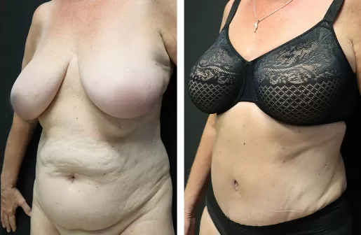 Tummy Tuck Tummy-Tuck-left