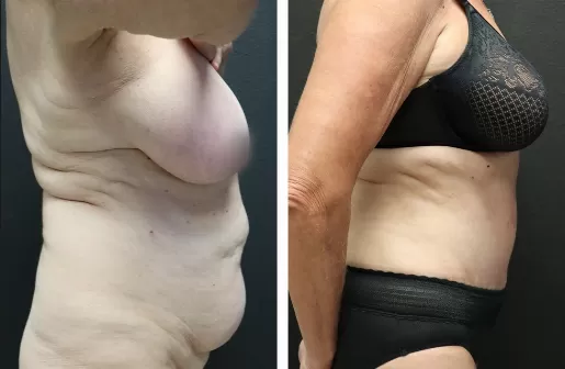 Tummy Tuck Tummy-Tuck-right-profile
