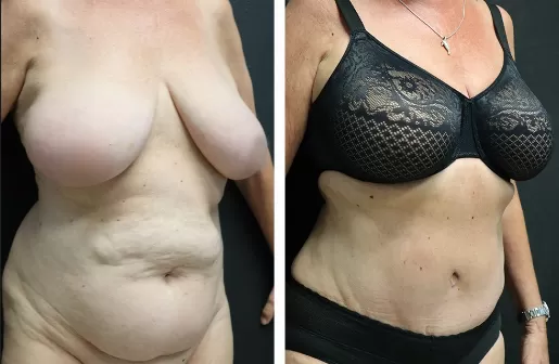 Tummy Tuck Tummy-Tuck-right