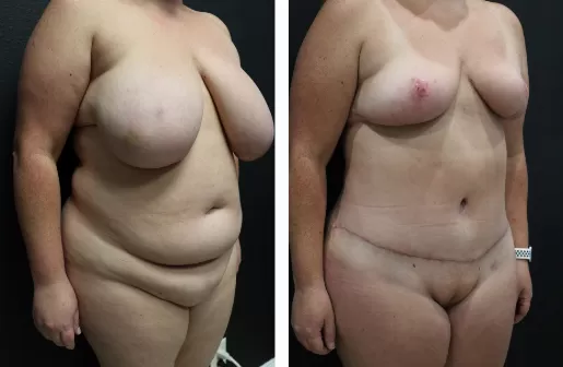 Tummy Tuck 04