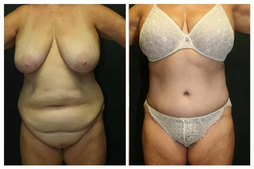 Tummy Tuck 03