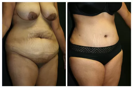 Tummy Tuck 01