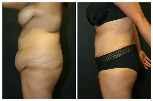 Tummy Tuck 02