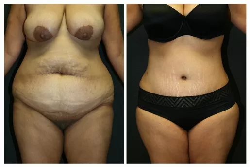 Tummy Tuck 03