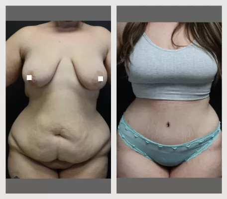 Tummy Tuck BA-1-1