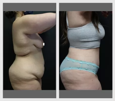 Tummy Tuck BA-2