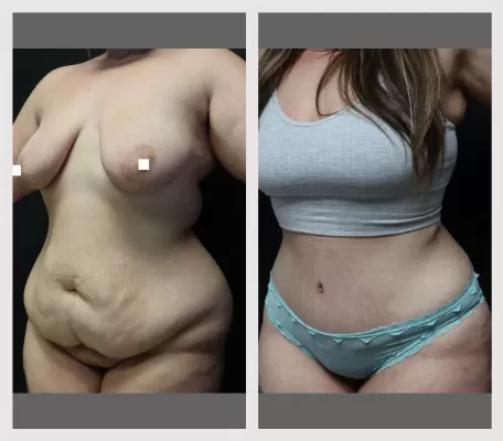 Tummy Tuck BA-3