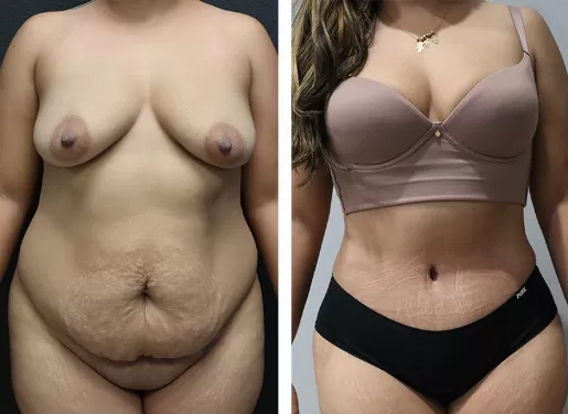 Tummy Tuck 04