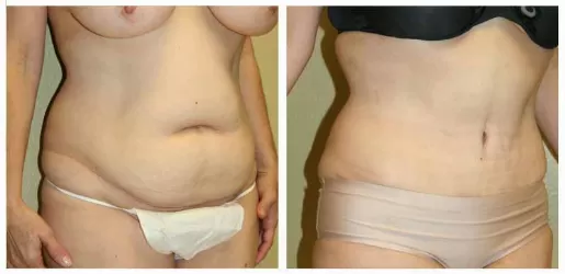 Tummy Tuck 03
