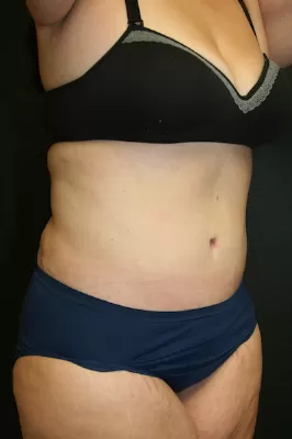 Tummy Tuck 04