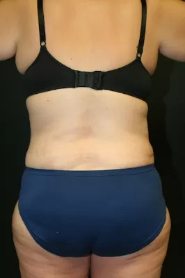 Tummy Tuck 06