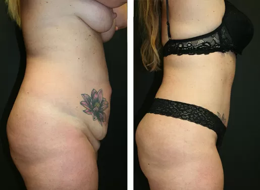Tummy Tuck 05