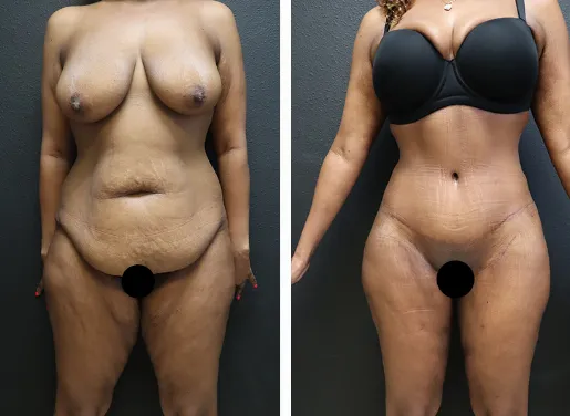 Tummy Tuck With Liposuction 01