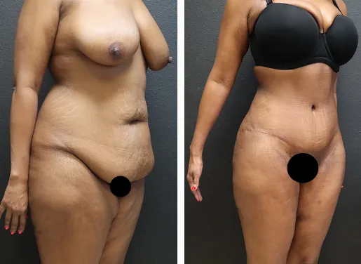 Tummy Tuck With Liposuction 02