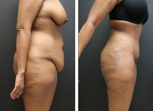 Tummy Tuck With Liposuction 03