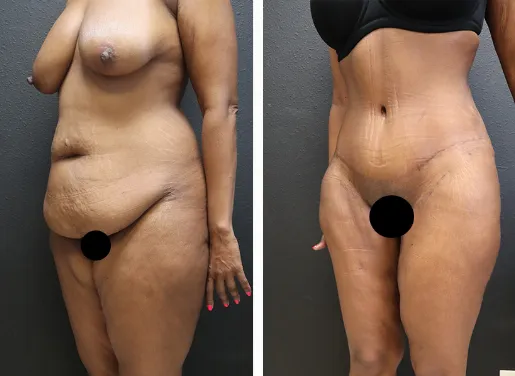 Tummy Tuck With Liposuction 04