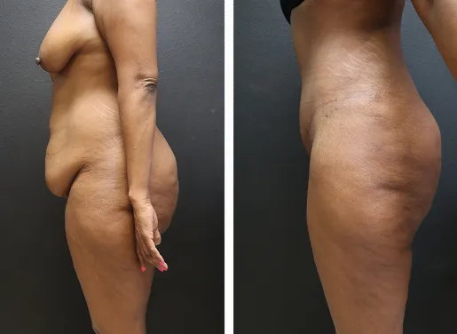Tummy Tuck With Liposuction 05