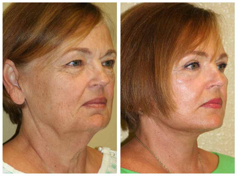 A Before & After Photo of a Mini Facelift Plastic Surgery by Dr. Alberico Sessa in Sarasota