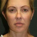 A Before Photo of a Blepharoplasty Plastic Surgery by Dr. Alberico Sessa in Sarasota