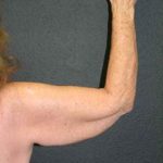 A Before Photo of an Arm Lift Plastic Surgery by Dr. Alberico Sessa in Sarasota