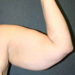 A Before Photo of an Arm Lift Plastic Surgery by Dr. Alberico Sessa in Sarasota