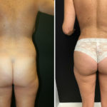 A Before & After of a Brazilian Butt Lift Plastic Surgery by Dr. Alberico Sessa in Sarasota