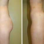 A Before & After of a Brazilian Butt Lift Plastic Surgery by Dr. Alberico Sessa in Sarasota