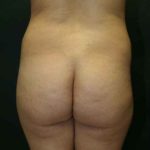 A Before Photo of a Brazilian Butt Lift Plastic Surgery by Dr. Alberico Sessa in Sarasota