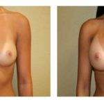 A Before & After of a Breast Augmentation Plastic Surgery by Dr. Alberico Sessa in Sarasota