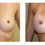 A Before & After of a Breast Augmentation Plastic Surgery by Dr. Alberico Sessa in Sarasota