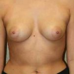 A Before Photo of a Breast Augmentation Plastic Surgery by Dr. Alberico Sessa In Sarasota
