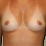 A Before Photo of a Breast Augmentation Plastic Surgery by Dr. Alberico Sessa In Sarasota