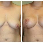A Before & After of a Breast Plastic Surgery by Dr. Alberico Sessa in Sarasota