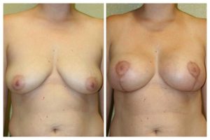 A Before & After of a Breast Plastic Surgery by Dr. Alberico Sessa in Sarasota