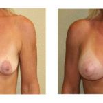 A Before & After of a Breast Lift Plastic Surgery by Dr. Alberico Sessa in Sarasota