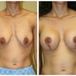 A Before & After of a Breast Lift Plastic Surgery by Dr. Alberico Sessa in Sarasota