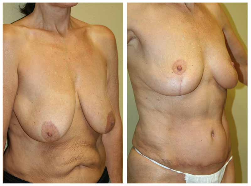 A Before & After of a Breast Lift With Reduction Plastic Surgery by Dr. Alberico Sessa in Sarasota