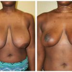 A Before & After of a Breast Lift With Reduction Plastic Surgery by Dr. Alberico Sessa in Sarasota