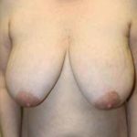 A Before Photo of a Breast Lift Plastic Surgery by Dr. Alberico Sessa In Sarasota